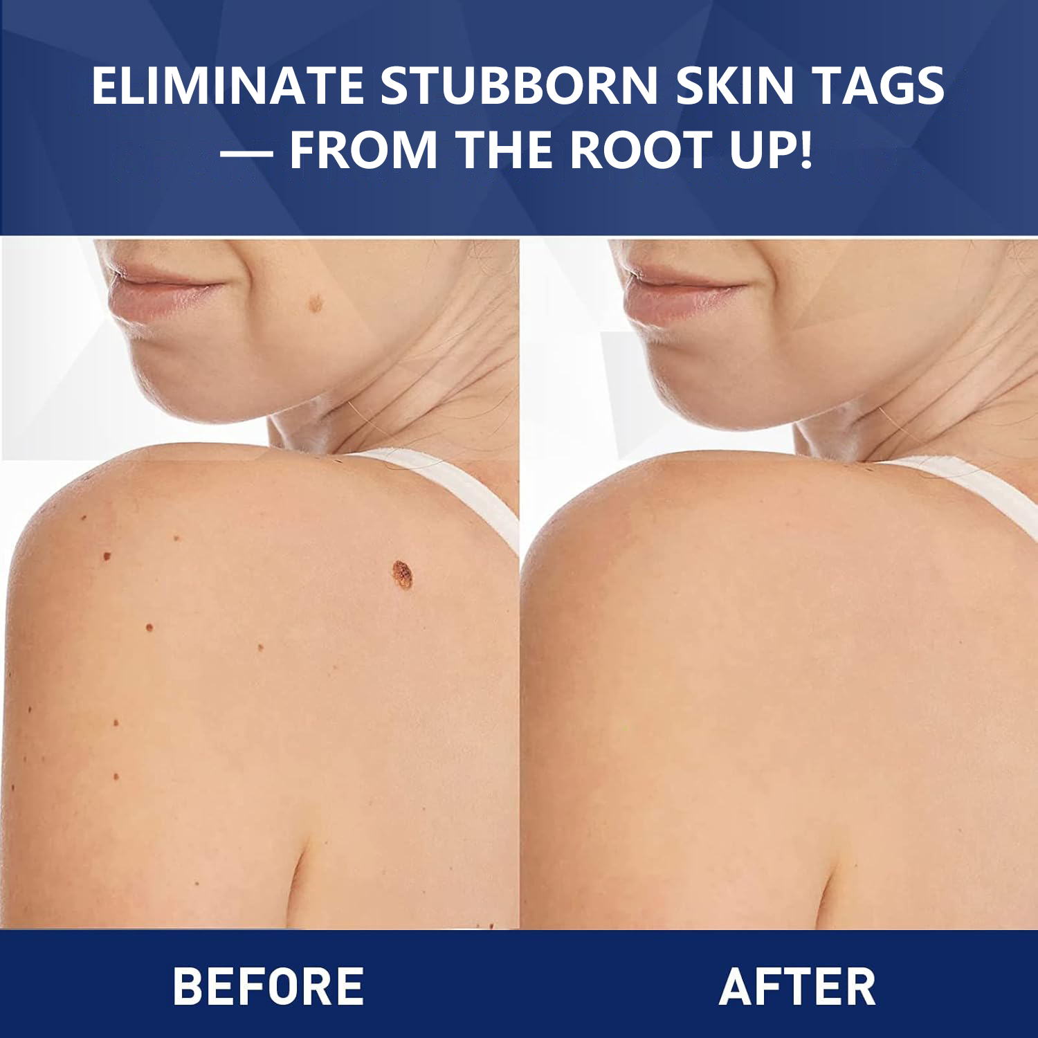 Before and after photo of stubborn neck and shoulder skin tags removed with TESEU skin tag remover