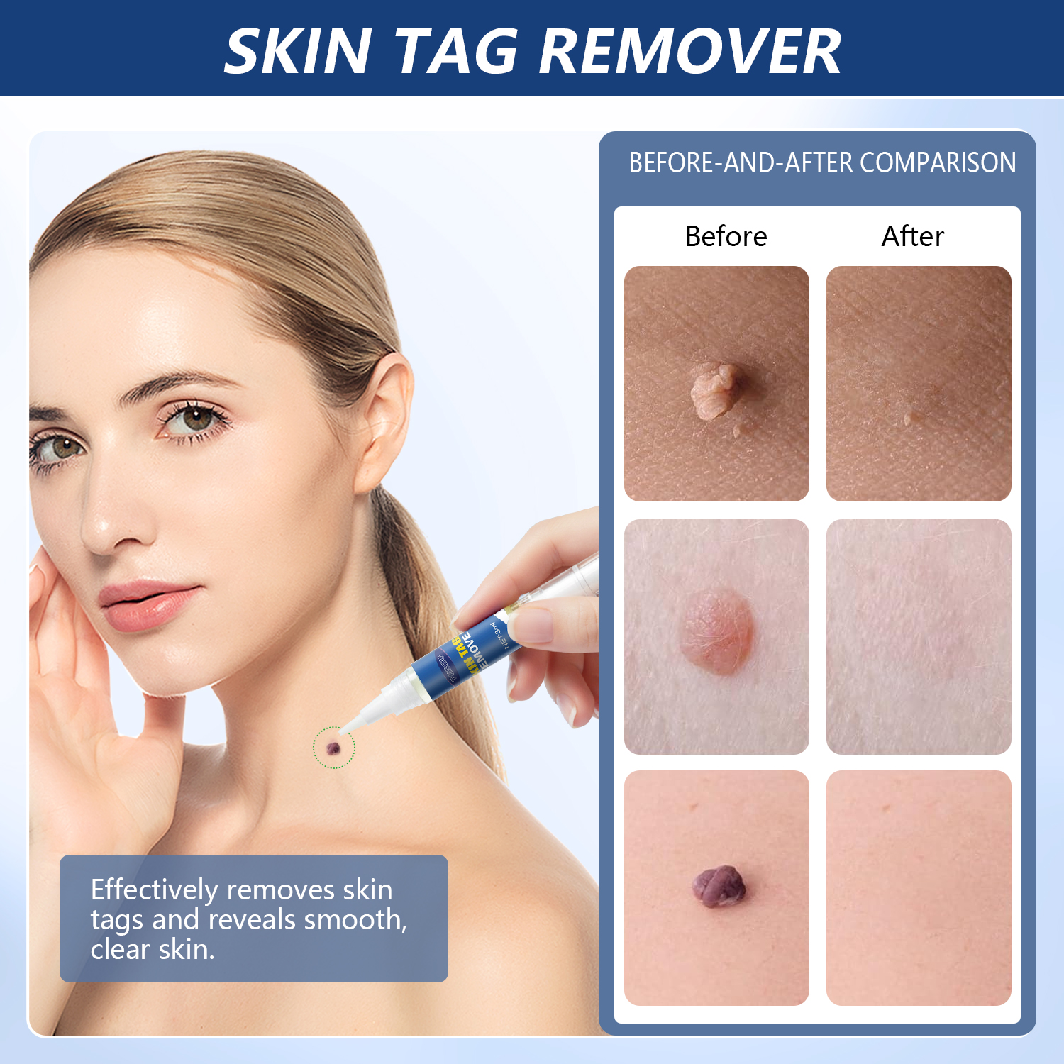 Woman applies TESEU skin tag remover to neck; before and after skin close-ups show smooth skin after use