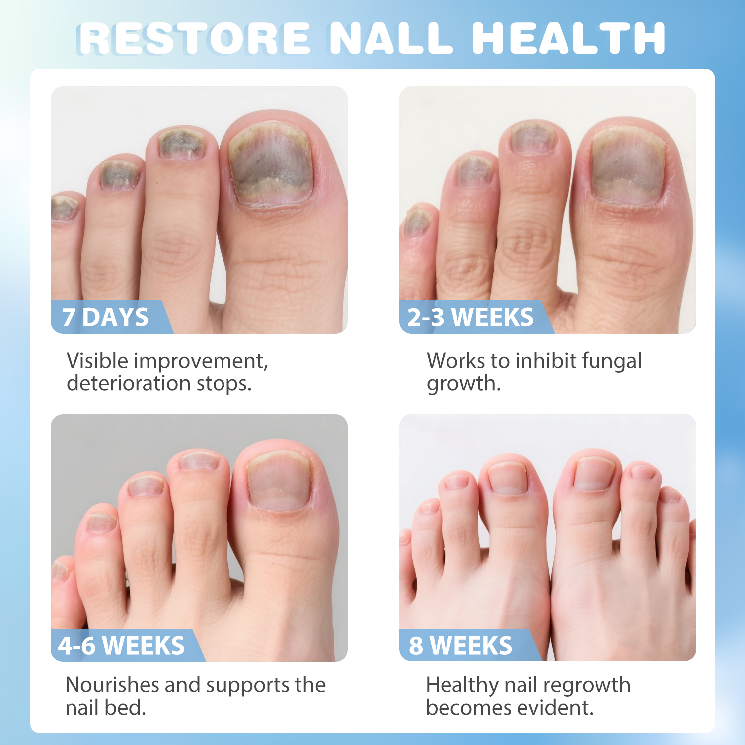 8-week progressive recovery timeline for damaged fungal toenails