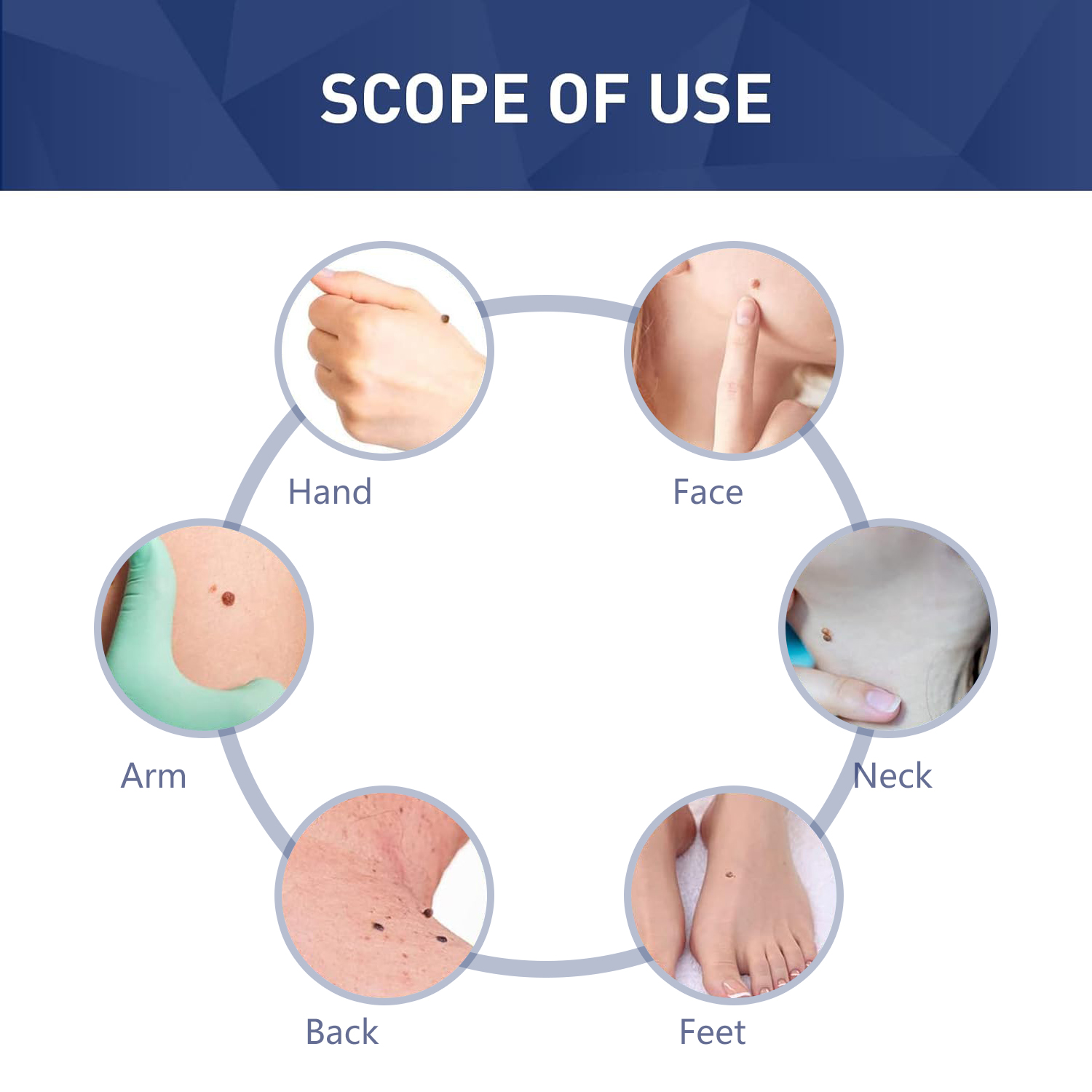 Circular scope of use infographic: TESEU skin tag remover works on face, neck, hands, arms, back and feet
