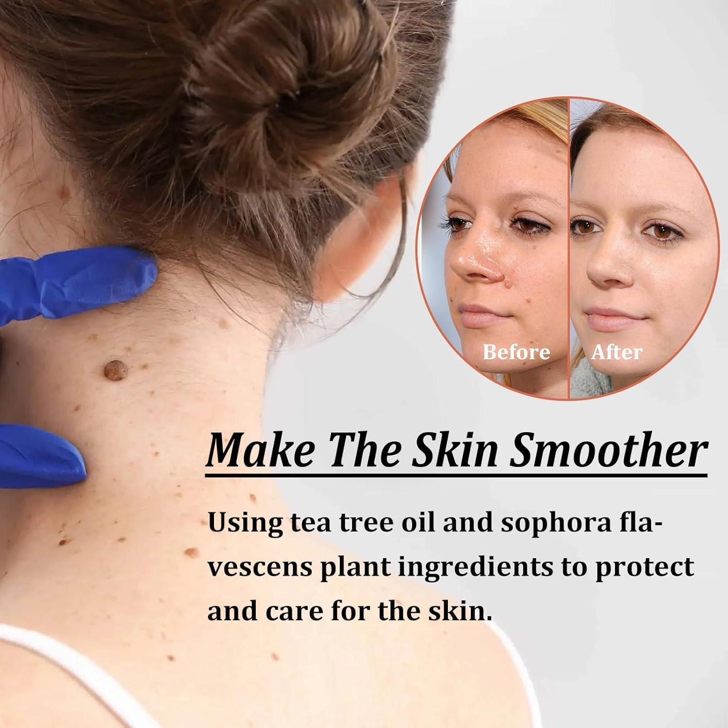 Neck skin tag before-after results, TESEU wart remover made with natural herbal ingredients