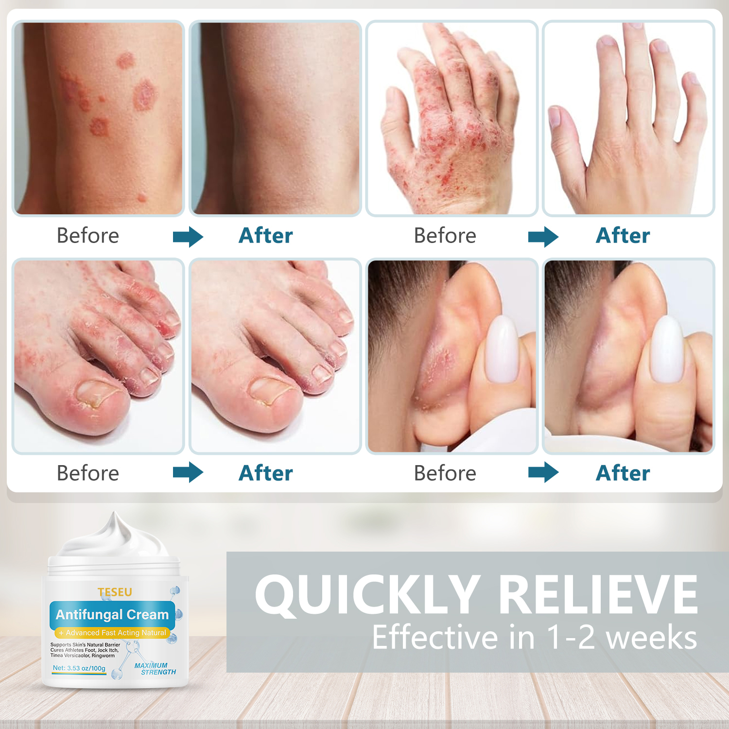 Four sets of before-after shots showing the antifungal cream's skin recovery effect
