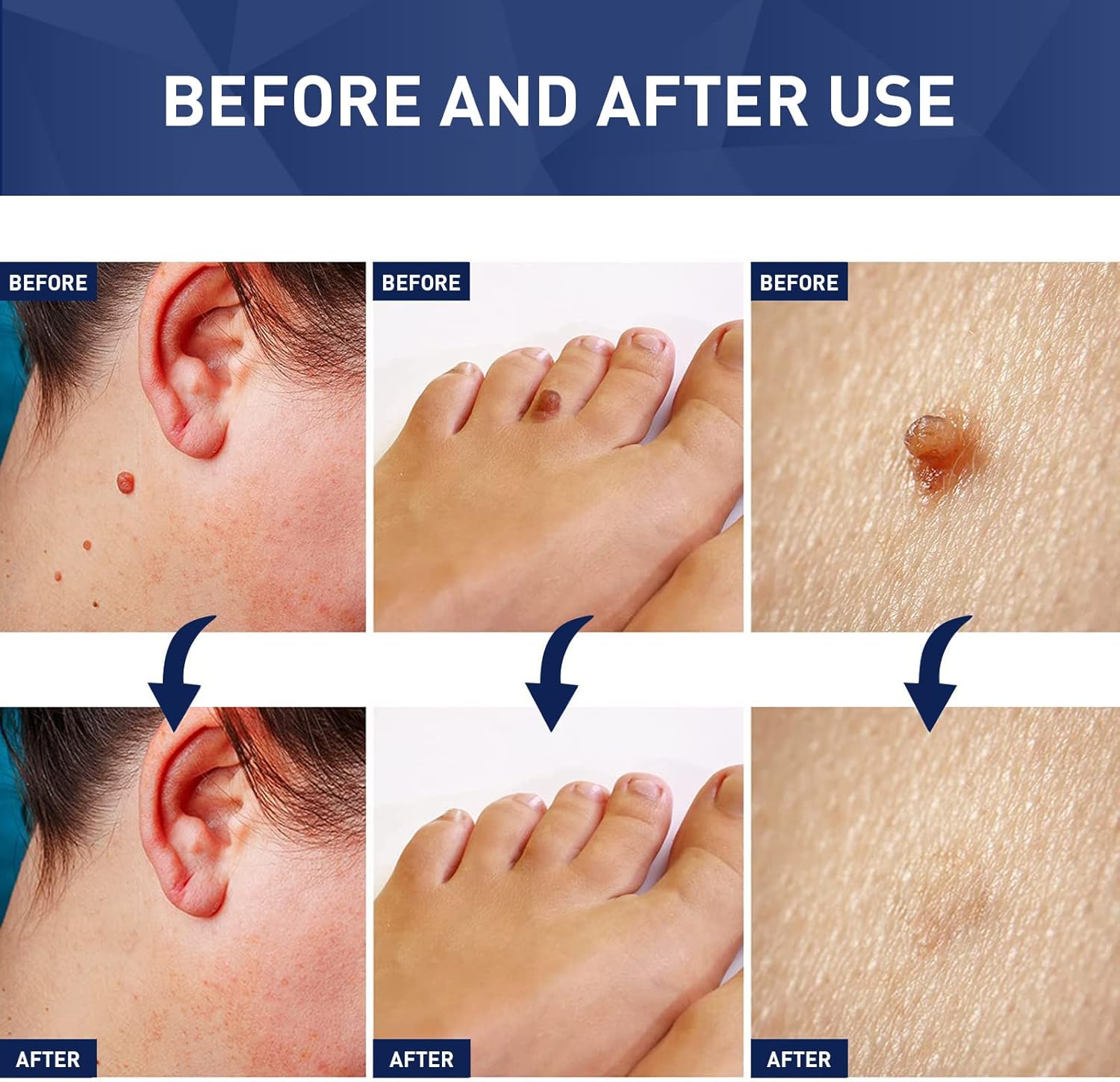 Three-panel before-after collage of skin tag removal results on cheek, toe and body skin with TESEU liquid
