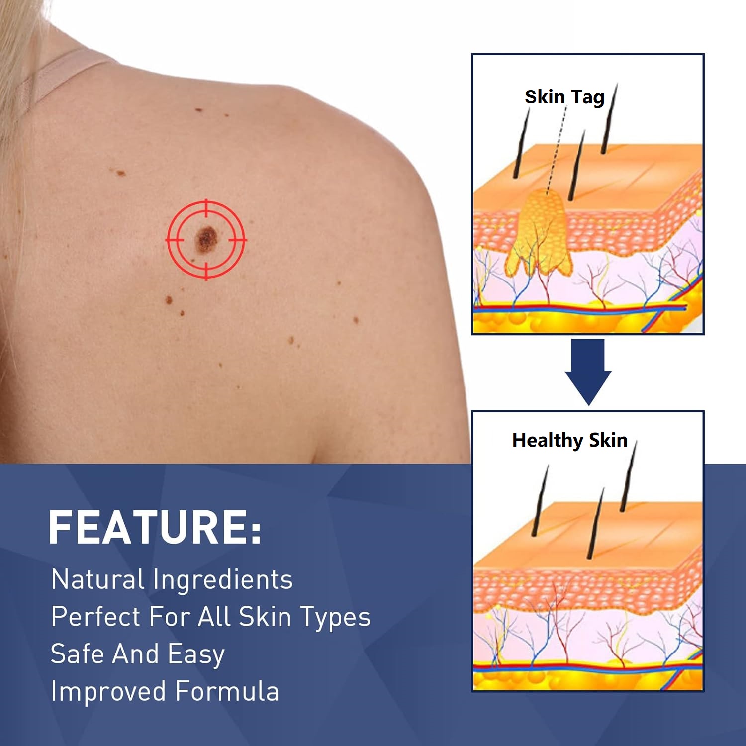Skin cross-section diagram showing TESEU natural formula clears skin tags, restoring healthy skin