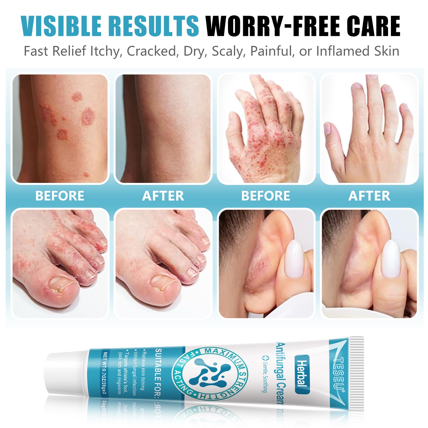 Before-and-after photos showing clear skin improvement after cream use