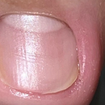 TESEU Fungal Nail Treatment