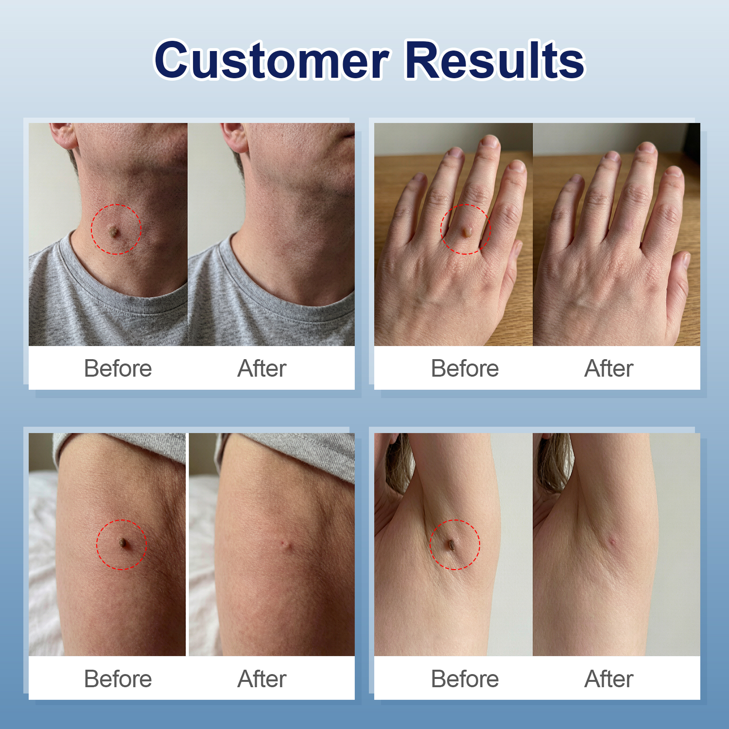 Four sets of before and after photos showing clear skin tag removal results