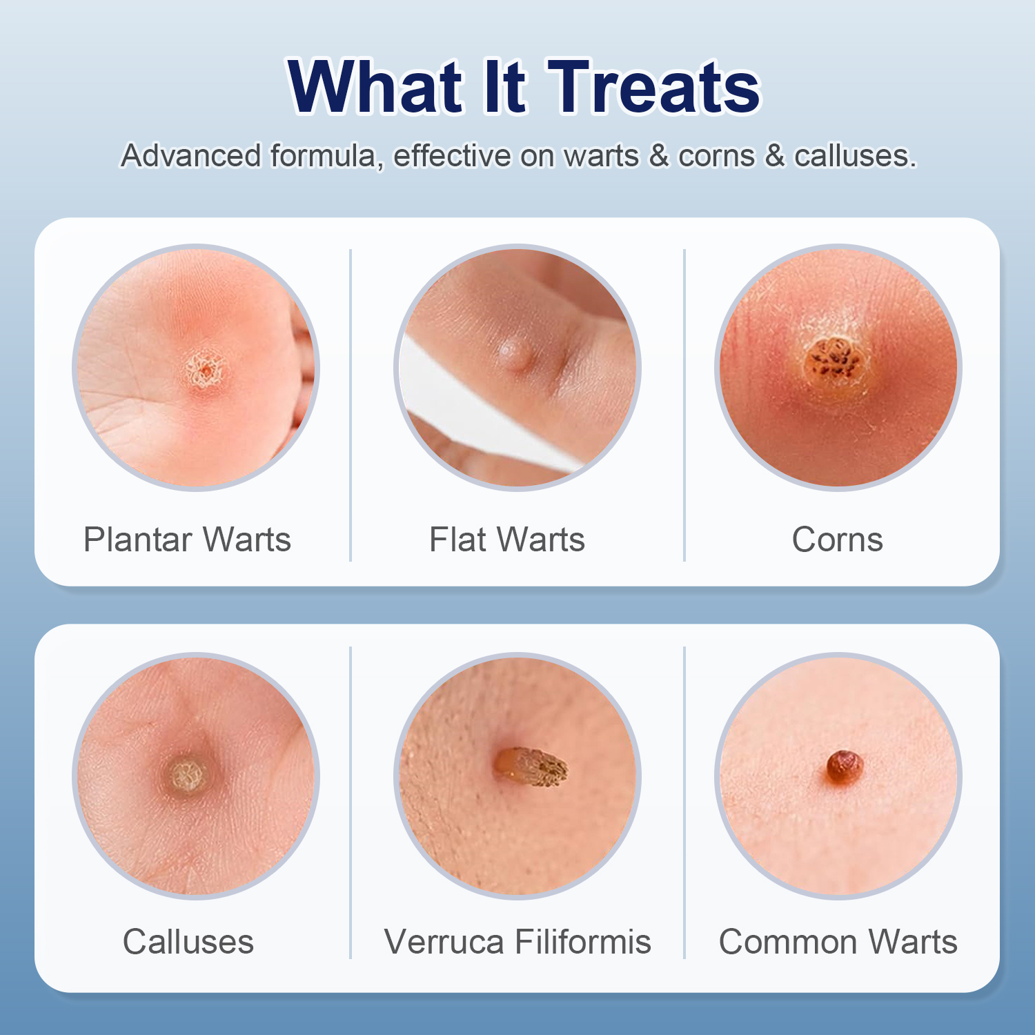 Infographic displaying six skin blemish types TESEU wart remover treats