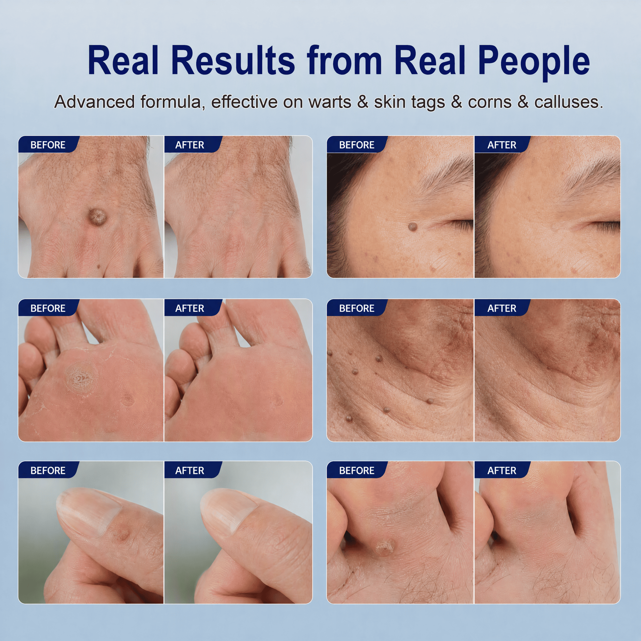 wart removal before after