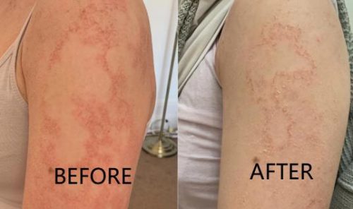 TESEU Antifungal Cream for Itch /  Ringworm Relief, 3 Pack photo review