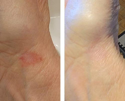 TESEU Antifungal Cream w/ Gentle Herbal Formula, 2 Pack photo review