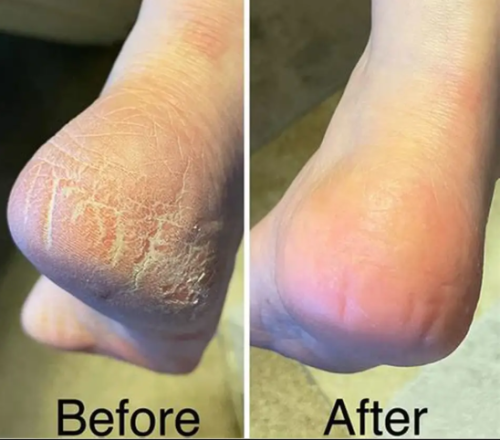 TESEU Antifungal Cream for Itch /  Ringworm Relief, 2 Pack photo review