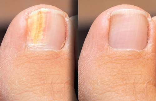 Click to view full screen TESEU Fungal Nail Liquid Extra Strong Treatment for Toenails photo review