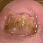 TESEU Fungal Nail Treatment Extra Strong for Toenails photo review