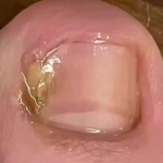 TESEU Fungal Nail Treatment Extra Strong for Toenails photo review