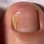 TESEU Fungal Nail Treatment Extra Strong for Toenails photo review