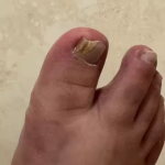 TESEU Extra-Strength Fungal Nail Liquid to Restore Healthy Nails photo review