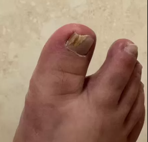 Click to view full screen TESEU Extra-Strength Fungal Nail Liquid to Restore Healthy Nails photo review