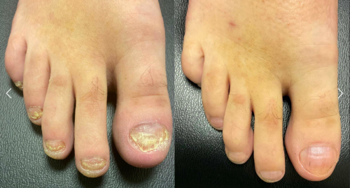Click to view full screen TESEU Fungal Nail Liquid Extra Strong Treatment for Toenails photo review
