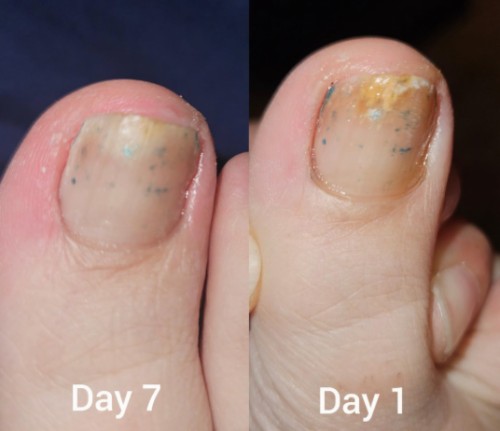 Click to view full screen TESEU Fungal Nail Liquid Extra Strong Treatment for Toenails photo review