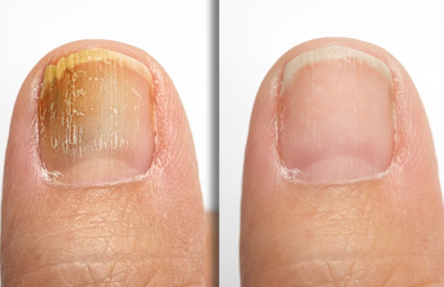 Click to view full screen TESEU Extra-Strength Fungal Nail Liquid to Restore Healthy Nails photo review