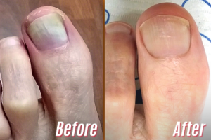 Click to view full screen TESEU Fungal Nail Liquid Extra Strong Treatment for Toenails photo review