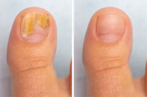 Click to view full screen TESEU Fungal Nail Treatment Extra Strong for Toenails photo review
