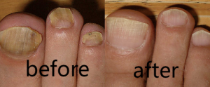 Click to view full screen TESEU Fungal Nail Treatment Extra Strong for Toenails photo review