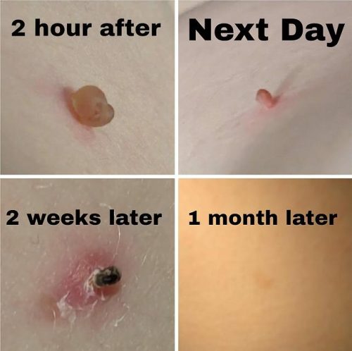 Click to view full screen TESEU Skin Tag Wart Removal, Precision Tip Fast-Acting, 2 Pack photo review