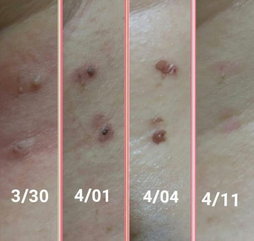 TESEU Wart Removal Skin Tag Removal Kit w/ Plant Extracts photo review