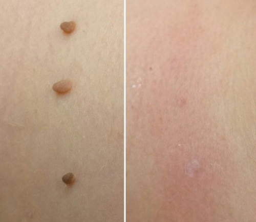 Click to view full screen TESEU Gentle Skin Tag & Wart Removal with Botanicals photo review
