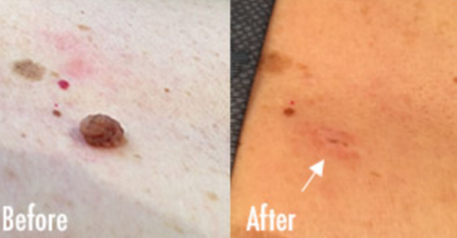 TESEU Wart Removal Skin Tag Removal Kit w/ Plant Extracts photo review