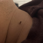TESEU Skin Tag Wart Removal Liquid w/ Strong Formula photo review