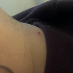 TESEU Skin Tag Wart Removal Liquid w/ Strong Formula photo review
