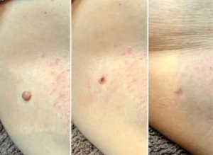 Click to view full screen TESEU Skin Tag Wart Removal, Precision Tip Fast-Acting, 2 Pack photo review