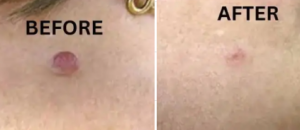 TESEU Skin Tag Wart Removal Liquid w/ Strong Formula photo review