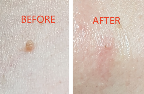 TESEU Wart Removal Gentle Effective for Skin Tag Verruca Corn photo review