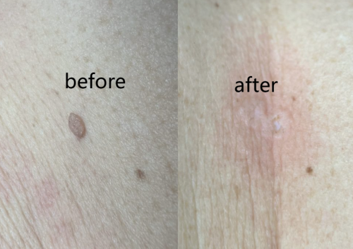TESEU Skin Tag Remover Pen Gentle Herbal Wart Removal, 4 Pack photo review