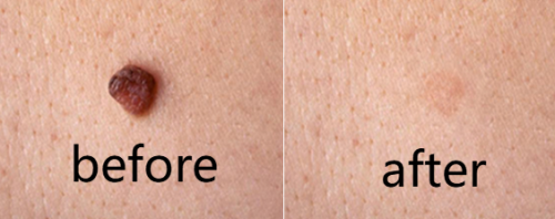 TESEU Wart Removal Gentle Effective for Skin Tag Verruca Corn photo review
