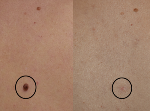 TESEU Wart Removal Gentle Effective for Skin Tag Verruca Corn photo review