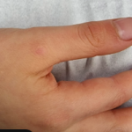 TESEU Skin Tag Wart Removal Liquid w/ Strong Formula photo review
