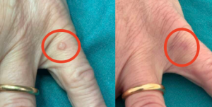 TESEU Skin Tag Wart Removal Liquid w/ Strong Formula photo review