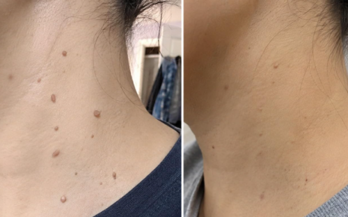 Click to view full screen TESEU Skin Tag Wart Removal w/ Gentle Botanical Extracts photo review