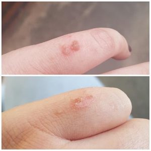 Click to view full screen TESEU Gentle Skin Tag & Wart Removal with Botanicals photo review