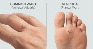 common warts and verrucas