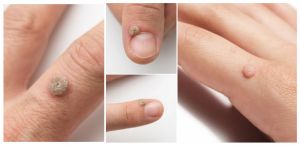 common warts