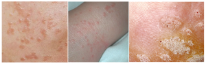 flat warts