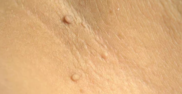 skin tag in groin