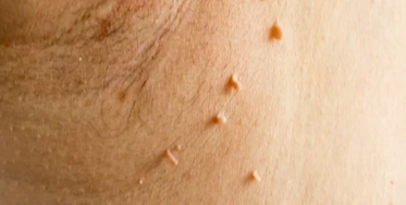 skin tag on armpit