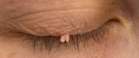 skin tag on eyelid